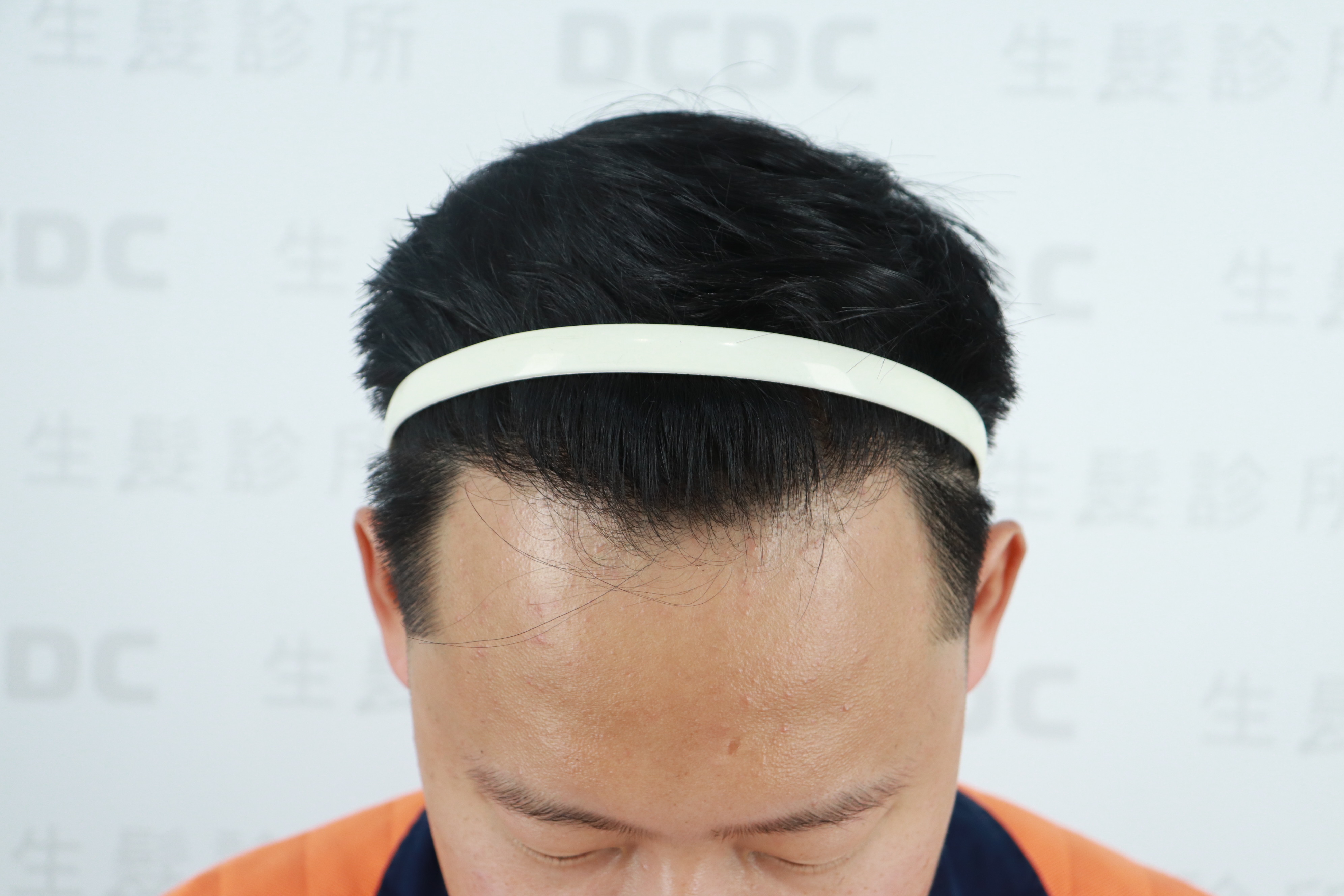 DCDC生髮診所-黃于甄醫師植髮6767根術後一年自然濃密正面成果
